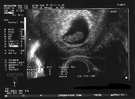 Laut Ultraschall &amp;quot;Twin A&amp;quot;