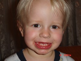 so ist mein zahnfleisch geschwollen, ich bekomme eckzähne.