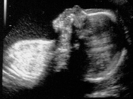 Linkes Kind im &amp;quot;normalen&amp;quot; US