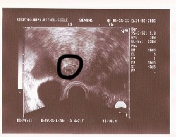 Us bild bei 5+1
<br />hcg wert 4558