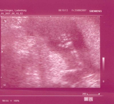 Knödelhand  SSW 14+6.JPG