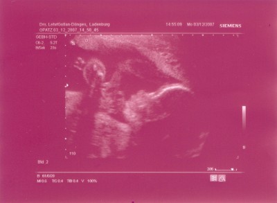 Knödelchen SSW 25+3.JPG