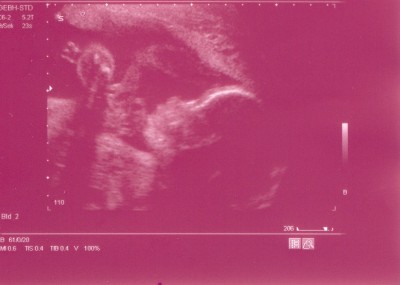 Knödel SSW 25+3.JPG