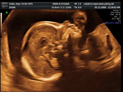 Stupsnase wie Malte damals.jpg