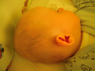 So sah der Hinterkopf bei Tim nach Physio aus. Platt wie eine Flunder und zur rechten Seite schief :-(